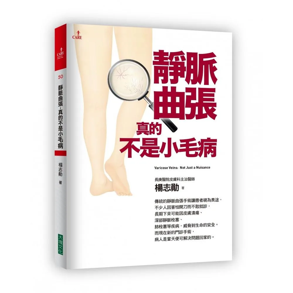 靜脈曲張，真的不是小毛病